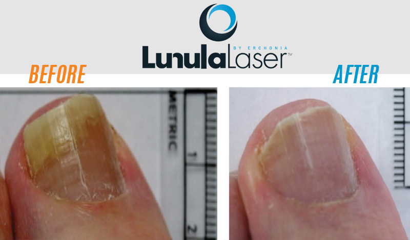 Laser Nail Fungus Before & After 1- OCfeet.com