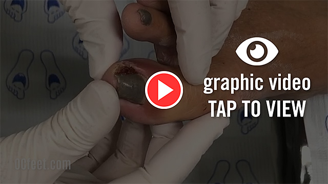 Ingrown Toenail surgery - OCfeet.com - Graphic Video - ap to view