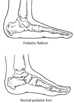  Pediatric Flatfoot_1 - OCfeet.com