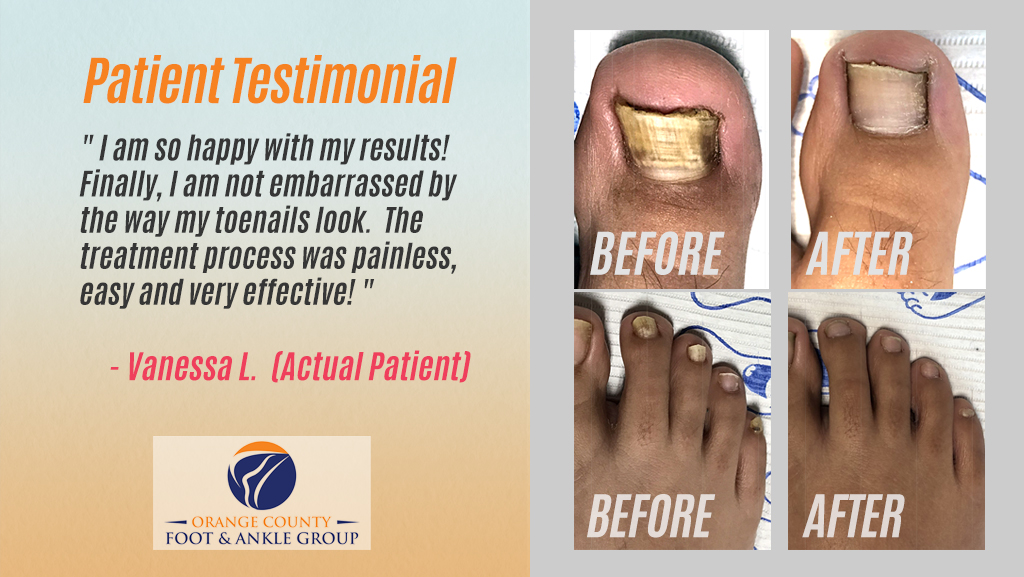 OCfeet.com - Patient Testimonial Vanessa L