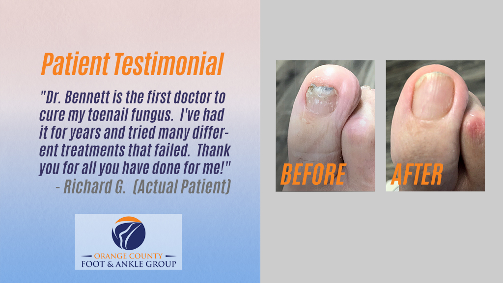 LASER_TESTIMONIALS_OCfeet.com