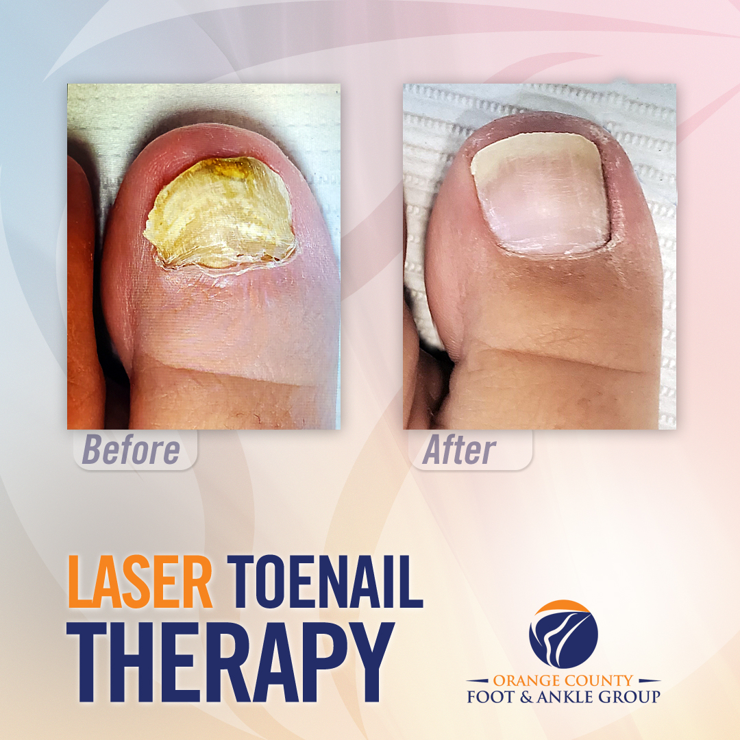 OCfeet.com - Laser Toenail Therapy - Orange County, CA