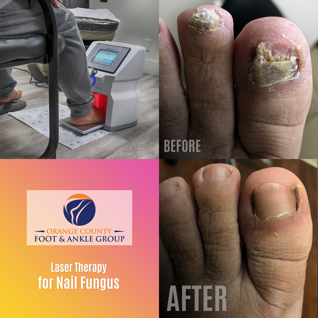 NYC Cost of Laser Toenail Fungus Treatment - Toenail Fungus NYC Laser