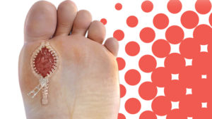 Diabetic Foot and wound care_1_OCfeet.com