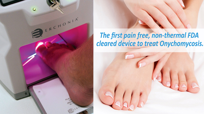 Laser Nail Fungus OCfeet.com