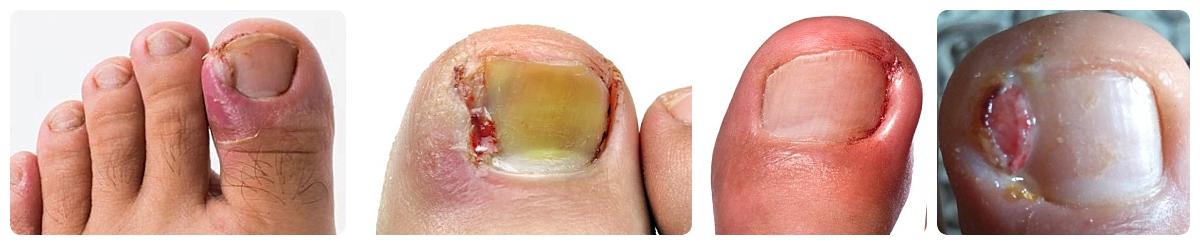 Ingrown Toenails