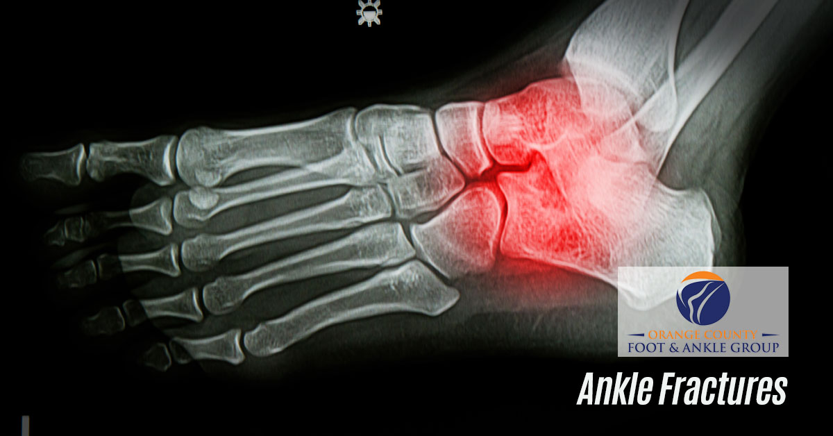 Ankle_Fractures_OCFA - OCfeet.com