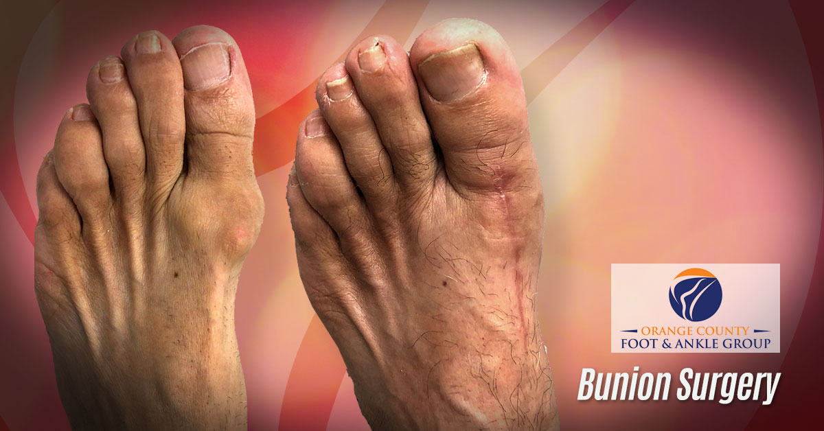 Bunion Surgery - OCFA - OCfeet.com