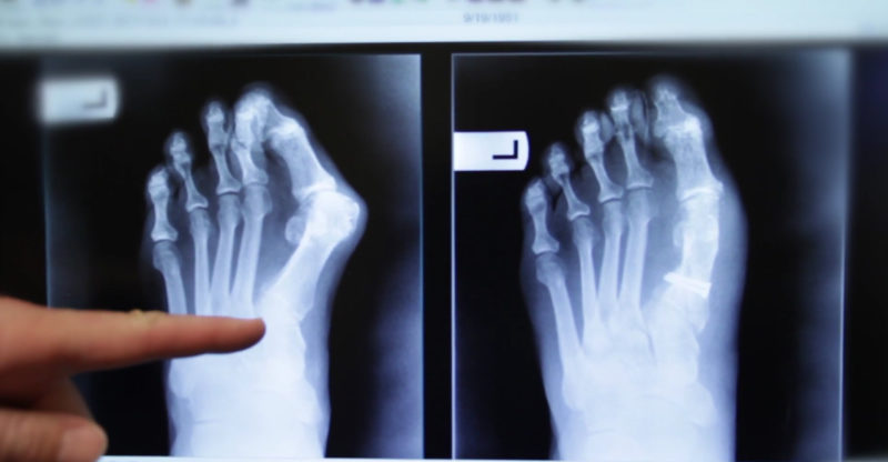 Bunion, OCfeet.com - surgery, x-ray