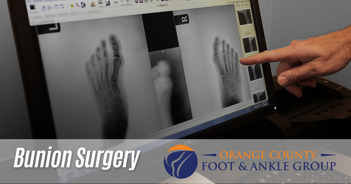 Bunion Surgery - Bunions - Orange County - OCfeet.com