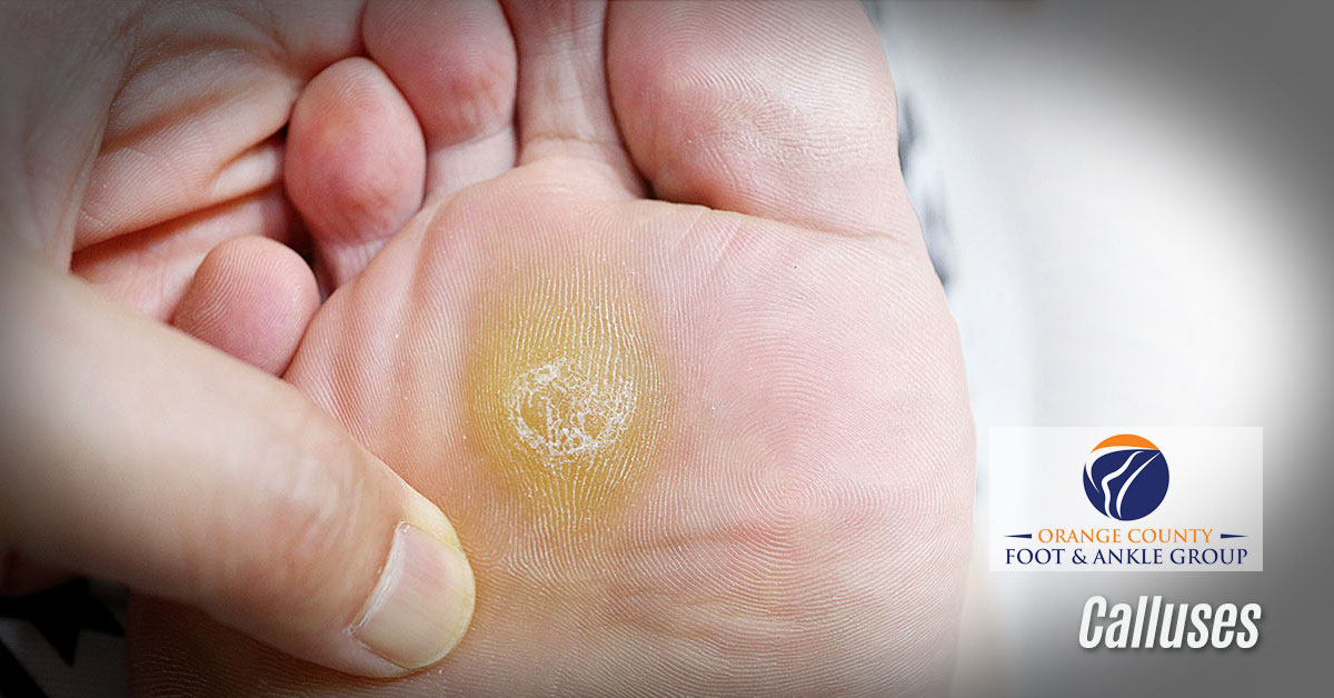 Calluses – OCFA – OCfeet.com Calluses - OCFA - OCfeet.com