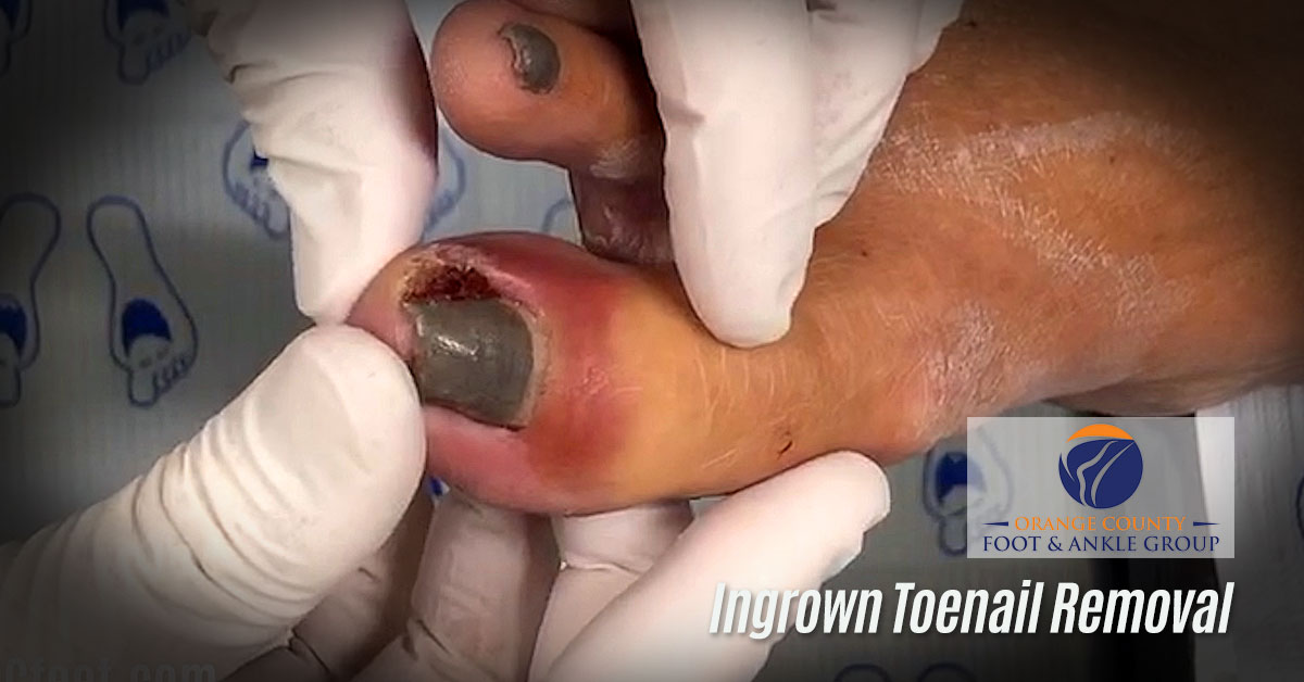 Ingrown toenail non-invasive treatment - The Foot Group