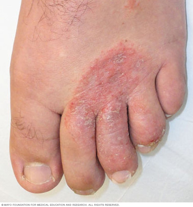Athlete's foot heel on sale