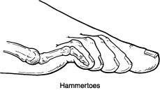 Hammer Toe 1 - OCfeet.com - Podiatry