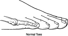 Hammer Toe 2 - OCfeet.com - Podiatry