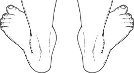  Pediatric Flatfoot_2 - OCfeet.com