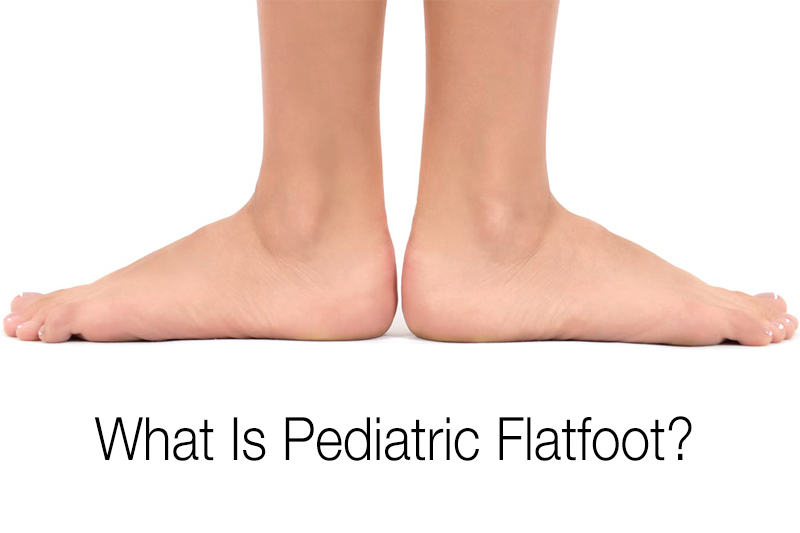 Pediatric Flatfoot - OCFeet.com