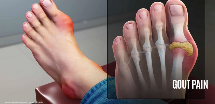 Gout Pain - OCFA