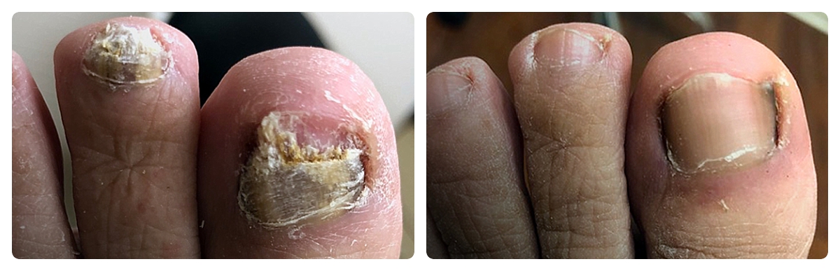 Before & After - Fungal Toenail