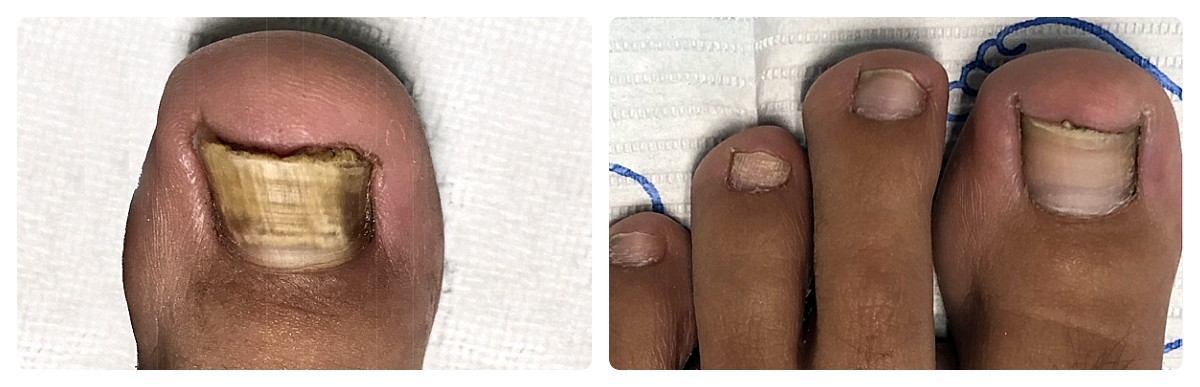 Before & After - Fungal Toenail