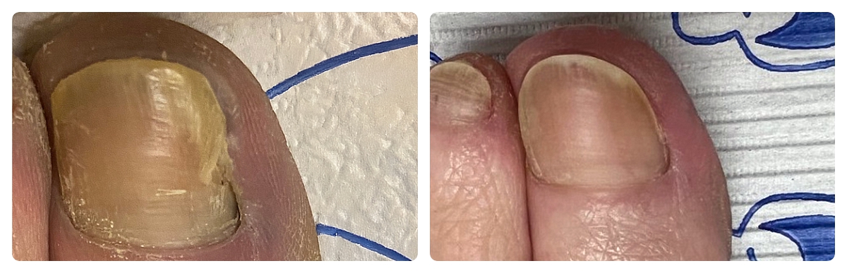 Before & After - Fungal Toenail