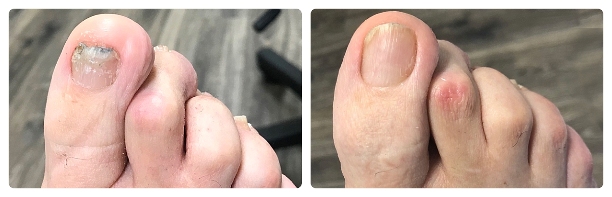 Before & After - Fungal Toenail