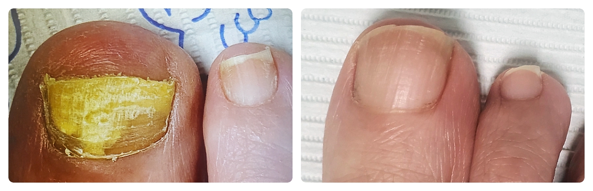 Before & After - Fungal Toenail
