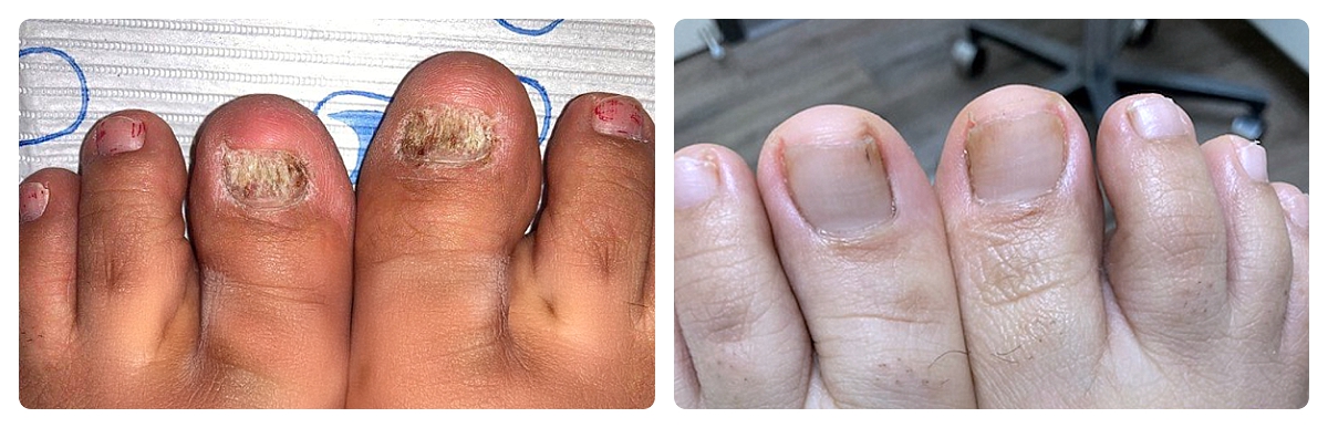 Before & After - Fungal Toenail