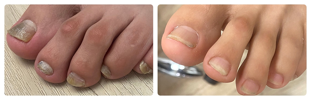 Before & After - Fungal Toenail