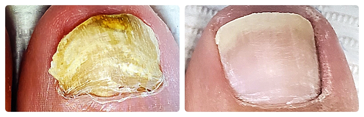 Before & After - Fungal Toenail